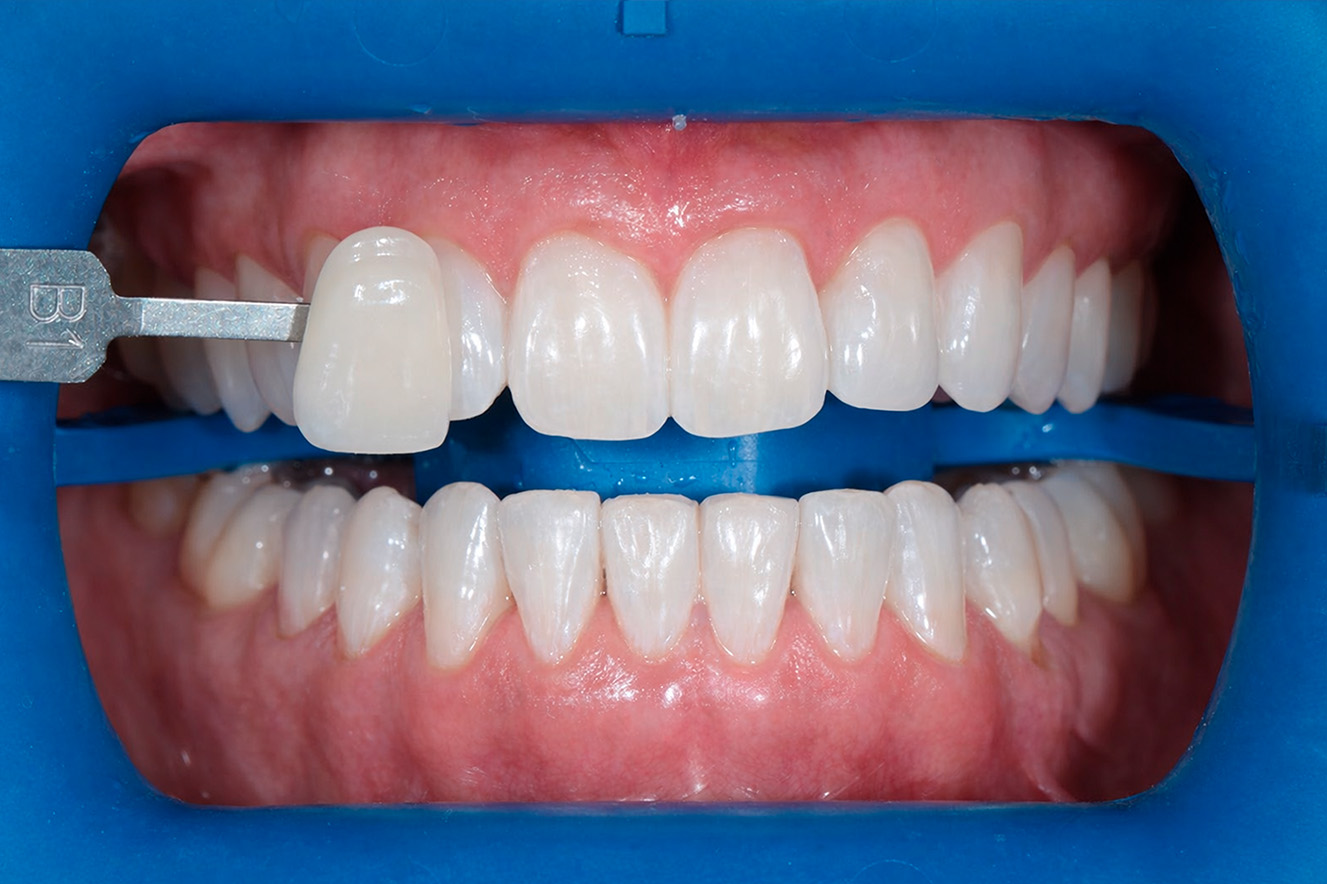 Отбеливание