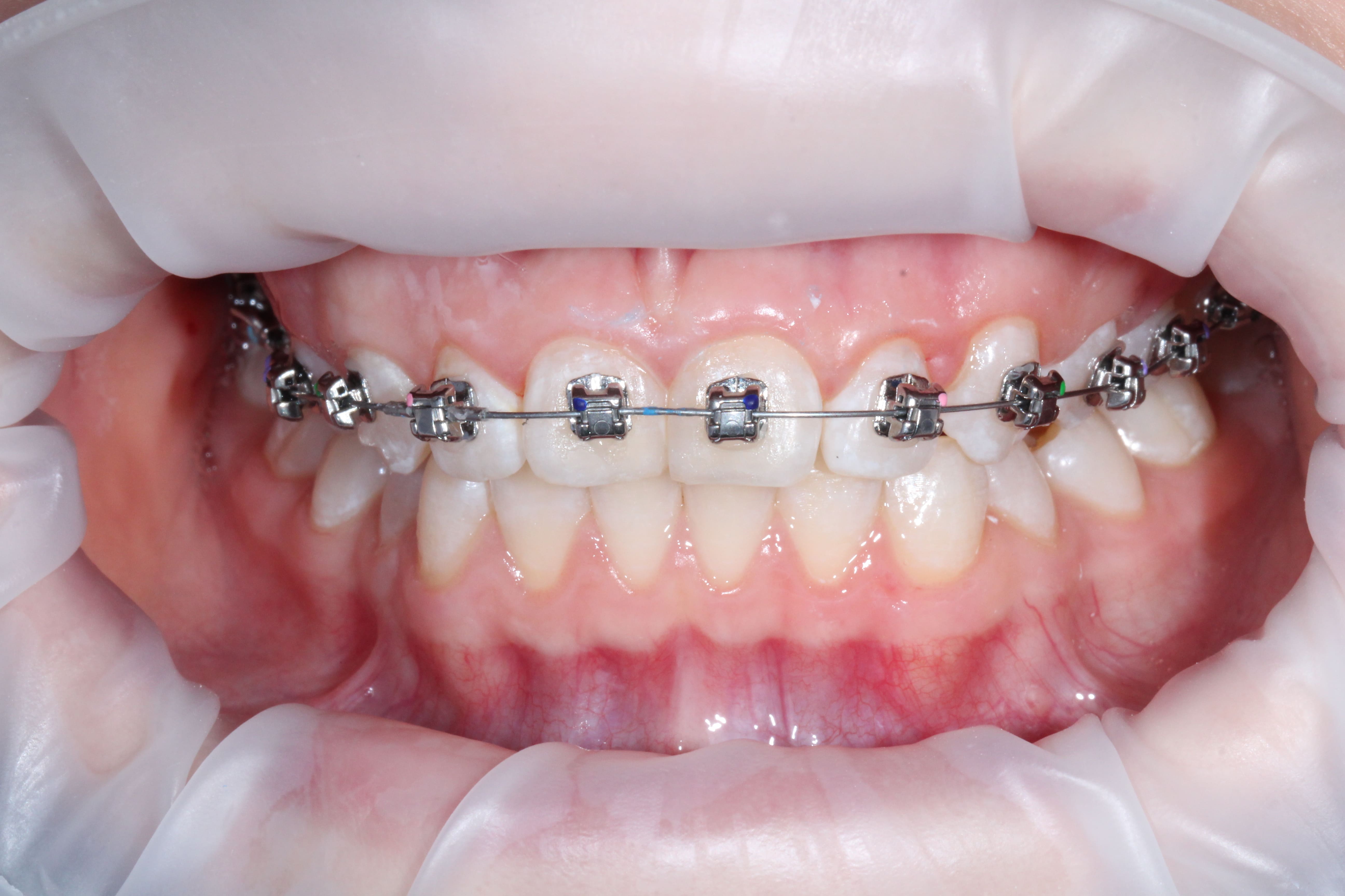 Установка брекет-системы — коррекция прикуса