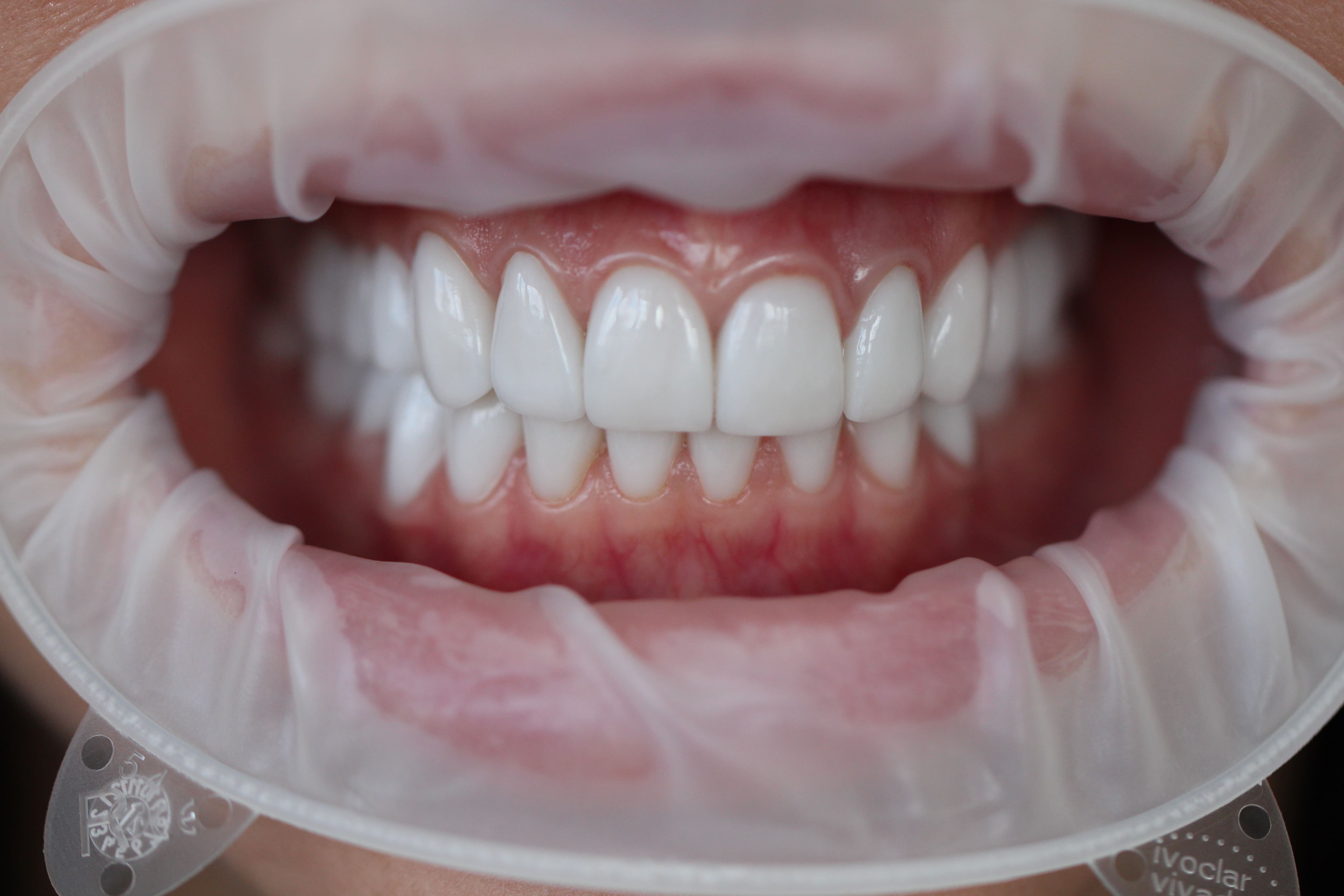 Виниры E-max — полное преображение улыбки — после