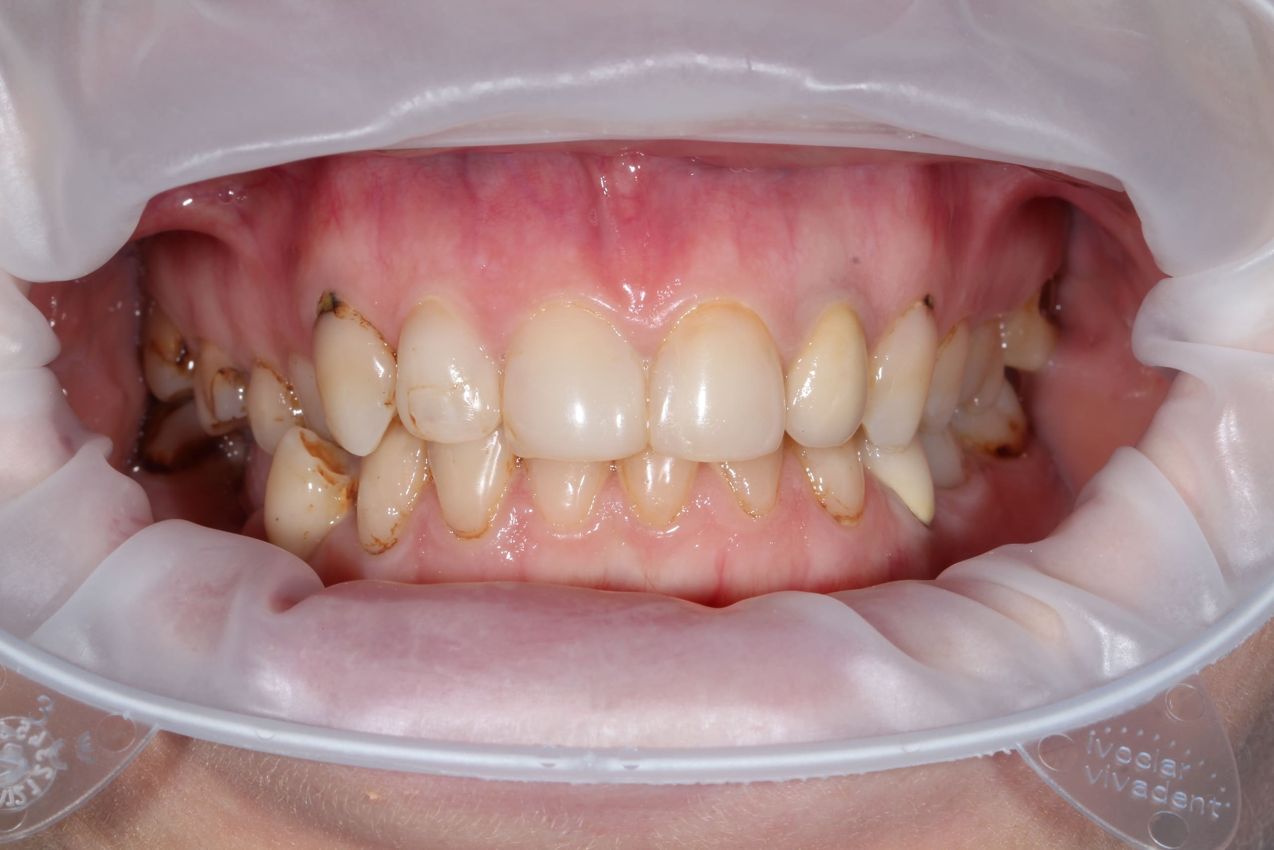 Виниры E-max — полное преображение улыбки — до