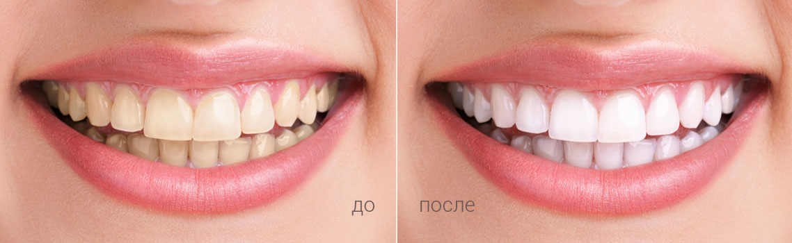 До и после процедуры зубного отбеливания