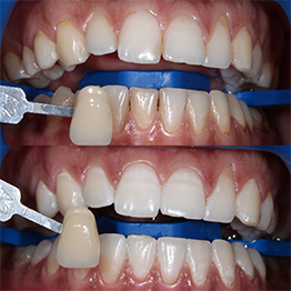 Отбеливание зубов Zoom 4. До и после процедуры.